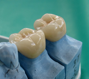 DENTAL CROWNS & VENEERS