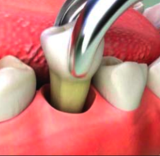 SURGICAL EXTRACTIONS