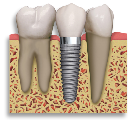 DENTAL IMPLANTS