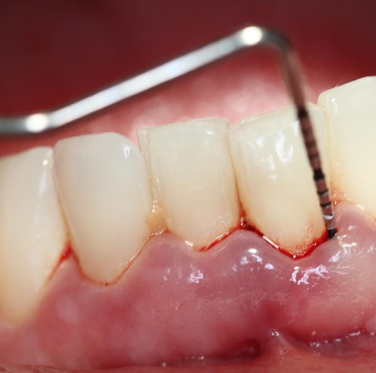 PERIODONTAL TREATMENT