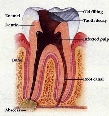 ROOT CANAL TREATMENT