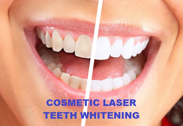 POWER BLEACHING / LASER TEETH WHITENING